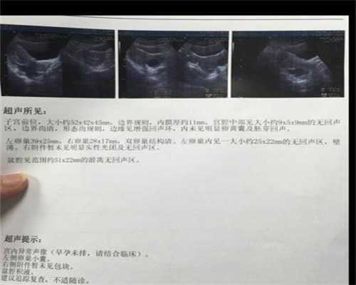 广州代孕多少钱：孕妇得阑尾炎怎么治疗才好呢