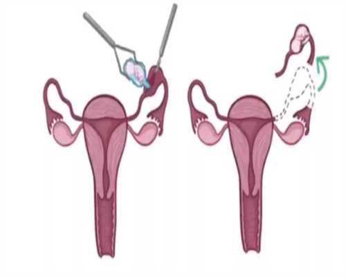 广州a时代助孕：做输卵管通液术后多长时间可以