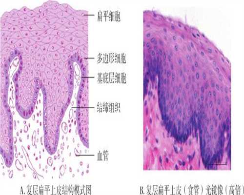 广州孕宝助孕：宫颈糜烂也会导致女性不孕的发